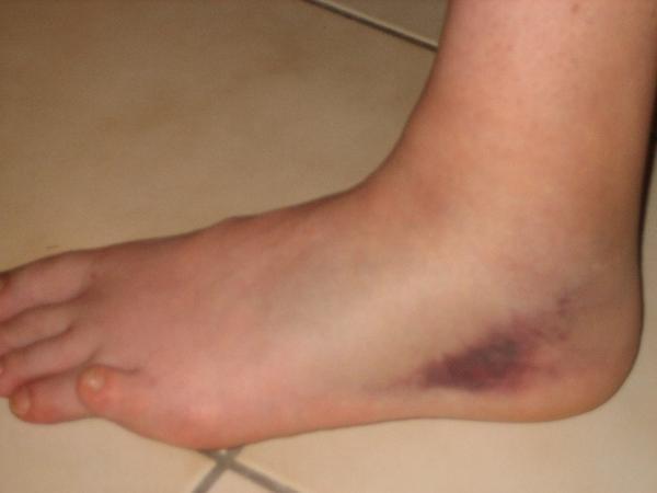 entorse ligament pied entorse ligament pied